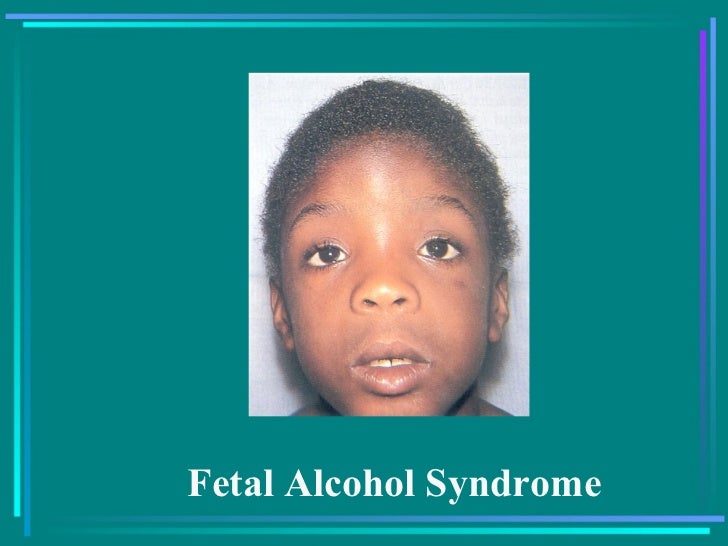 Alcohol essay fetal syndrome