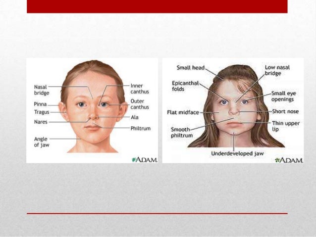 Alcohol symptoms syndrome fetal of Fetal Alcohol