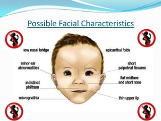 Fetal alcohol syndrome | PPT