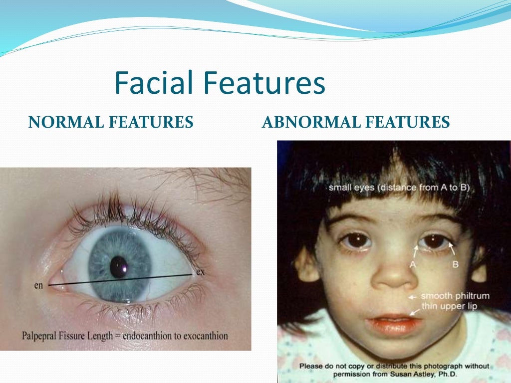 Fetal alcohol syndrome