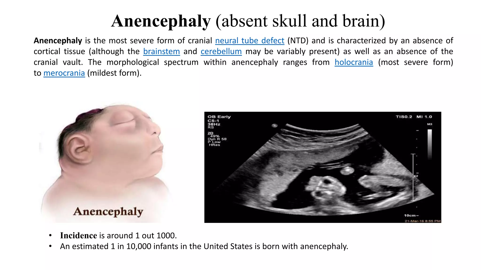 Anencephaly (absent skull and brain)
• Incidence is around 1 out 1000.
• An estimated 1 in 10,000 infants in the United States is born with anencephaly.
Anencephaly is the most severe form of cranial neural tube defect (NTD) and is characterized by an absence of
cortical tissue (although the brainstem and cerebellum may be variably present) as well as an absence of the
cranial vault. The morphological spectrum within anencephaly ranges from holocrania (most severe form)
to merocrania (mildest form).
 