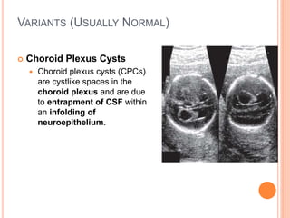 VARIANTS (USUALLY NORMAL)
 Choroid Plexus Cysts
 Choroid plexus cysts (CPCs)
are cystlike spaces in the
choroid plexus and are due
to entrapment of CSF within
an infolding of
neuroepithelium.
 