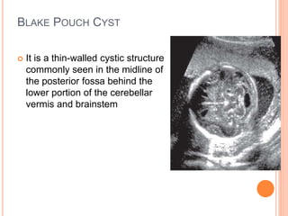 BLAKE POUCH CYST
 It is a thin-walled cystic structure
commonly seen in the midline of
the posterior fossa behind the
lower portion of the cerebellar
vermis and brainstem
 