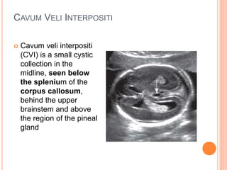 CAVUM VELI INTERPOSITI
 Cavum veli interpositi
(CVI) is a small cystic
collection in the
midline, seen below
the splenium of the
corpus callosum,
behind the upper
brainstem and above
the region of the pineal
gland
 