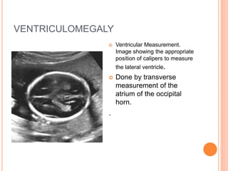 VENTRICULOMEGALY
 Ventricular Measurement.
Image showing the appropriate
position of calipers to measure
the lateral ventricle.
 Done by transverse
measurement of the
atrium of the occipital
horn.
.
 