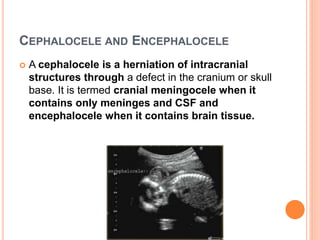 CEPHALOCELE AND ENCEPHALOCELE
 A cephalocele is a herniation of intracranial
structures through a defect in the cranium or skull
base. It is termed cranial meningocele when it
contains only meninges and CSF and
encephalocele when it contains brain tissue.
 