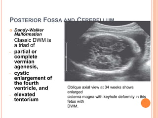 POSTERIOR FOSSA AND CEREBELLUM
 Dandy-Walker
Malformation
Classic DWM is
a triad of
- partial or
complete
vermian
agenesis,
- cystic
enlargement of
the fourth
ventricle, and
- elevated
tentorium
Oblique axial view at 34 weeks shows
enlarged
cisterna magna with keyhole deformity in this
fetus with
DWM.
 