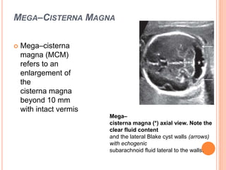 MEGA–CISTERNA MAGNA
 Mega–cisterna
magna (MCM)
refers to an
enlargement of
the
cisterna magna
beyond 10 mm
with intact vermis
Mega–
cisterna magna (*) axial view. Note the
clear fluid content
and the lateral Blake cyst walls (arrows)
with echogenic
subarachnoid fluid lateral to the walls.
 