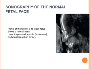 SONOGRAPHY OF THE NORMAL
FETAL FACE
Profile of the face of a 18-week fetus
shows a normal nasal
bone (long arrow), maxilla (arrowhead),
and mandible (short arrow).
 