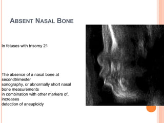 ABSENT NASAL BONE
In fetuses with trisomy 21
The absence of a nasal bone at
secondtrimester
sonography, or abnormally short nasal
bone measurements
in combination with other markers of,
increases
detection of aneuploidy
 