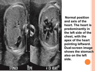 Normal position
and axis of the
heart. The heart is
predominantly in
the left side of the
chest, with the
apex of the heart
pointing leftward.
Dual-screen image
shows the stomach
also on the left
side.
 