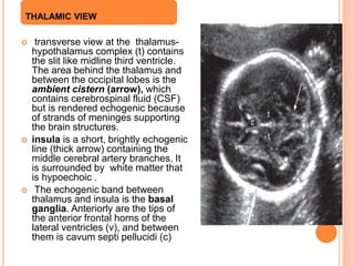  transverse view at the thalamus-
hypothalamus complex (t) contains
the slit like midline third ventricle.
The area behind the thalamus and
between the occipital lobes is the
ambient cistern (arrow), which
contains cerebrospinal fluid (CSF)
but is rendered echogenic because
of strands of meninges supporting
the brain structures.
 insula is a short, brightly echogenic
line (thick arrow) containing the
middle cerebral artery branches. It
is surrounded by white matter that
is hypoechoic .
 The echogenic band between
thalamus and insula is the basal
ganglia. Anteriorly are the tips of
the anterior frontal horns of the
lateral ventricles (v), and between
them is cavum septi pellucidi (c)
THALAMIC VIEWview
 