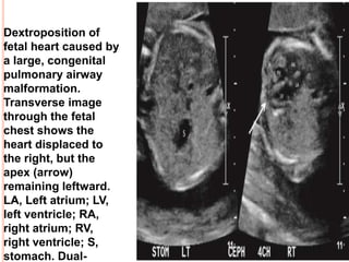 Dextroposition of
fetal heart caused by
a large, congenital
pulmonary airway
malformation.
Transverse image
through the fetal
chest shows the
heart displaced to
the right, but the
apex (arrow)
remaining leftward.
LA, Left atrium; LV,
left ventricle; RA,
right atrium; RV,
right ventricle; S,
stomach. Dual-
 