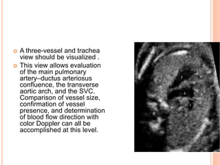  A three-vessel and trachea
view should be visualized .
 This view allows evaluation
of the main pulmonary
artery–ductus arteriosus
confluence, the transverse
aortic arch, and the SVC.
Comparison of vessel size,
confirmation of vessel
presence, and determination
of blood flow direction with
color Doppler can all be
accomplished at this level.
 