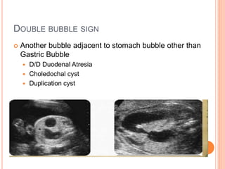 DOUBLE BUBBLE SIGN
 Another bubble adjacent to stomach bubble other than
Gastric Bubble
 D/D Duodenal Atresia
 Choledochal cyst
 Duplication cyst
 