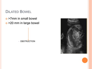 DILATED BOWEL
 >7mm in small bowel
 >20 mm in large bowel
 OBSTRUCTION
 