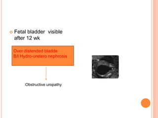  Fetal bladder visible
after 12 wk
Over distended bladde
B/l Hydro-uretero nephrosis
Obstructive uropathy
 