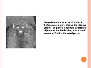 Transabdominal scan at 19 weeks in
the transverse plane shows the kidneys
(arrows) as paired isoechoic structures
adjacent to the fetal spine, with a small
amount of fluid in the renal pelvis.
 