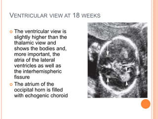 VENTRICULAR VIEW AT 18 WEEKS
 The ventricular view is
slightly higher than the
thalamic view and
shows the bodies and,
more important, the
atria of the lateral
ventricles as well as
the interhemispheric
fissure
 The atrium of the
occipital horn is filled
with echogenic choroid
 