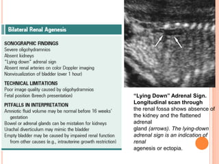 “Lying Down” Adrenal Sign.
Longitudinal scan through
the renal fossa shows absence of
the kidney and the flattened
adrenal
gland (arrows). The lying-down
adrenal sign is an indication of
renal
agenesis or ectopia.
 