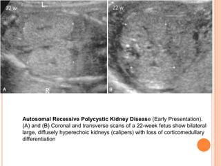 Autosomal Recessive Polycystic Kidney Disease (Early Presentation).
(A) and (B) Coronal and transverse scans of a 22-week fetus show bilateral
large, diffusely hyperechoic kidneys (calipers) with loss of corticomedullary
differentiation
 