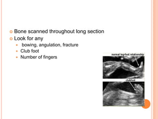  Bone scanned throughout long section
 Look for any
 bowing, angulation, fracture
 Club foot
 Number of fingers
 