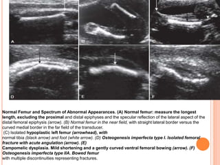 Normal Femur and Spectrum of Abnormal Appearances. (A) Normal femur: measure the longest
length, excluding the proximal and distal epiphyses and the specular reflection of the lateral aspect of the
distal femoral epiphysis (arrow). (B) Normal femur in the near field, with straight lateral border versus the
curved medial border in the far field of the transducer.
(C) Isolated hypoplastic left femur (arrowhead), with
normal tibia (black arrow) and foot (white arrow). (D) Osteogenesis imperfecta type I. Isolated femoral
fracture with acute angulation (arrow). (E)
Campomelic dysplasia. Mild shortening and a gently curved ventral femoral bowing (arrow). (F)
Osteogenesis imperfecta type IIA. Bowed femur
with multiple discontinuities representing fractures.
 