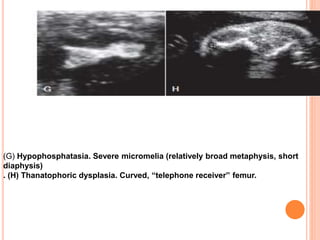 (G) Hypophosphatasia. Severe micromelia (relatively broad metaphysis, short
diaphysis)
. (H) Thanatophoric dysplasia. Curved, “telephone receiver” femur.
 