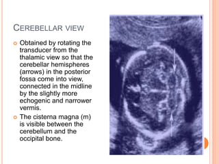 CEREBELLAR VIEW
 Obtained by rotating the
transducer from the
thalamic view so that the
cerebellar hemispheres
(arrows) in the posterior
fossa come into view,
connected in the midline
by the slightly more
echogenic and narrower
vermis.
 The cisterna magna (m)
is visible between the
cerebellum and the
occipital bone.
 