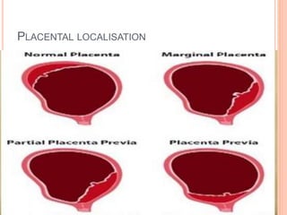 PLACENTAL LOCALISATION
 