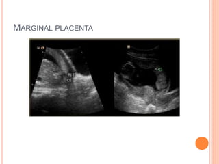 MARGINAL PLACENTA
 