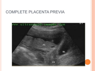 COMPLETE PLACENTA PREVIA
 
