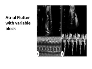 fetal arrhythmia diagnosis and management | PPT