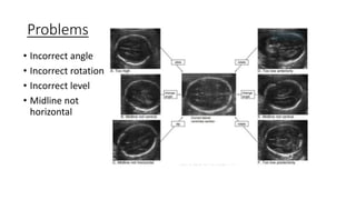 Problems
• Incorrect angle
• Incorrect rotation
• Incorrect level
• Midline not
horizontal
 