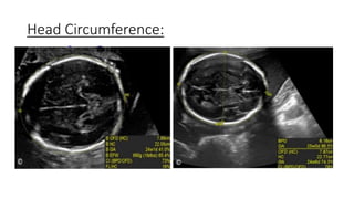 Head Circumference:
 