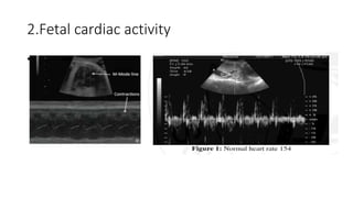 2.Fetal cardiac activity
•
 