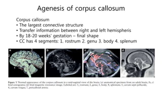 Genu Splenum Fetal brain anomalies | PPTX