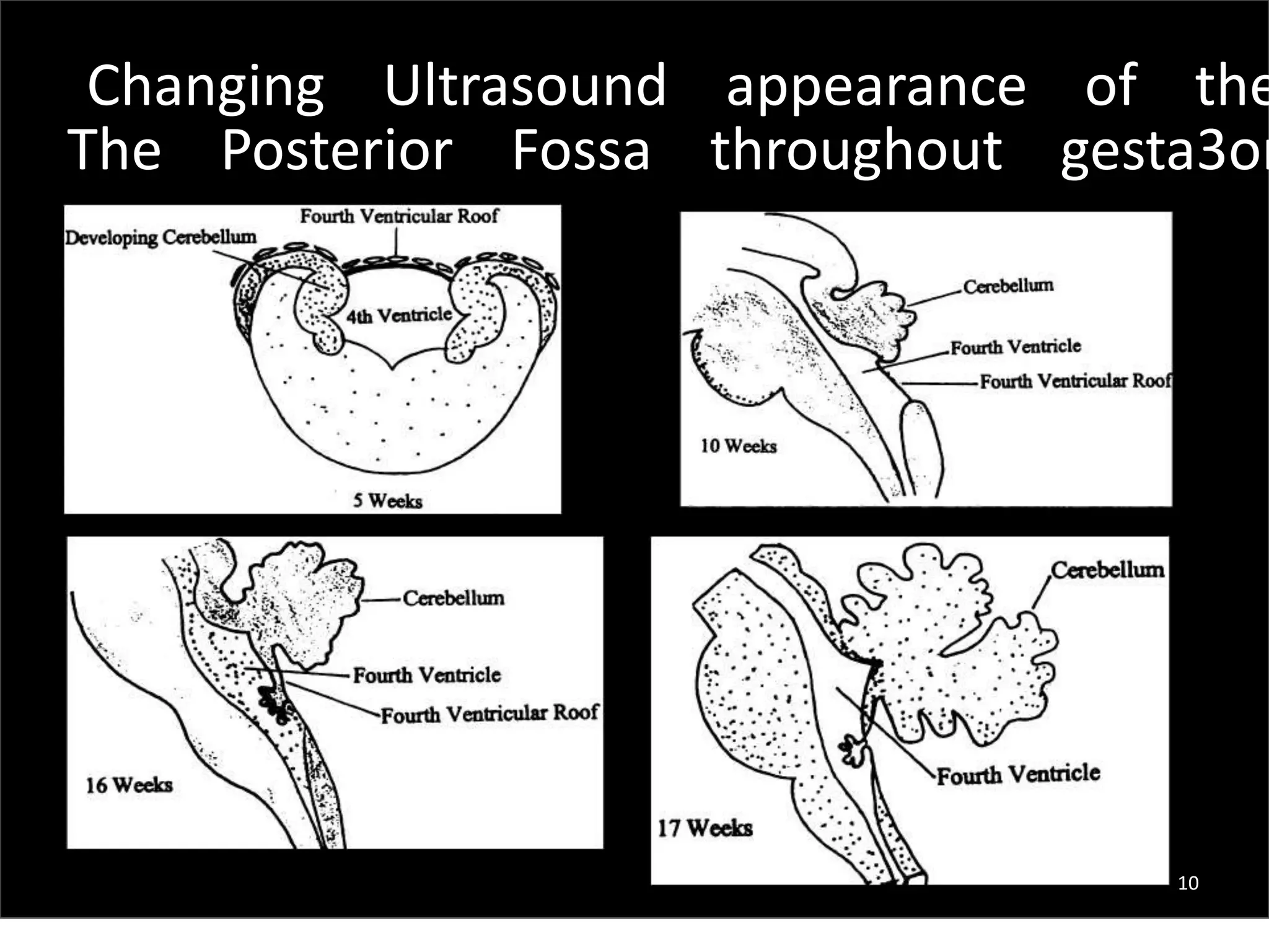 Fetal brain usg 1 | PPTX