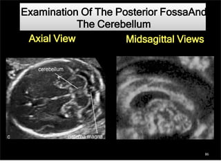 Examination Of The Posterior FossaAnd
The Cerebellum
Midsagittal ViewsAxial View
86
 