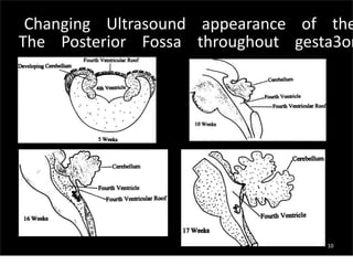 10
Changing Ultrasound appearance of the
The Posterior Fossa throughout gesta3on
 