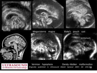 Originally published in Ultrasound Obstet Gynecol 2007; 30: 233–245
Normal Megacisterna magna
Vermian hypoplasia
Blake’s pouch cyst
tentorium
Dandy-‐Walker malforma3on
89
 