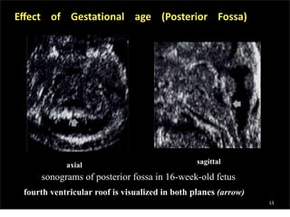 sagittalaxial
Eﬀect of Gestational age (Posterior Fossa)
sonograms of posterior fossa in 16-week-old fetus
fourth ventricular roof is visualized in both planes (arrow)
13
 