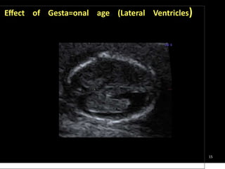 15
Eﬀect of Gesta=onal age (Lateral Ventricles)
 