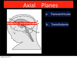 Axial Planes
a: Transventricular
b: Transthalamic
Sunday, July 28, 13
 