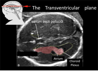 The Transventricular plane
Frontal hones
Choroid
Plexus
Atrium
Sunday, July 28, 13
 