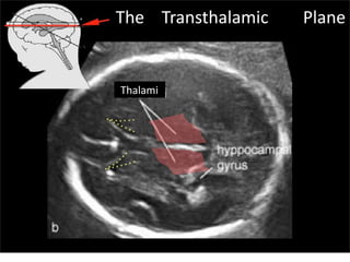 Thalami
The Transthalamic Plane
Sunday, July 28, 13
 