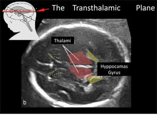 Thalami
Hyppocamas
Gyrus
The Transthalamic Plane
Sunday, July 28, 13
 