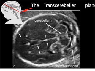 T
T
The Transcerebeller plane
Sunday, July 28, 13
 