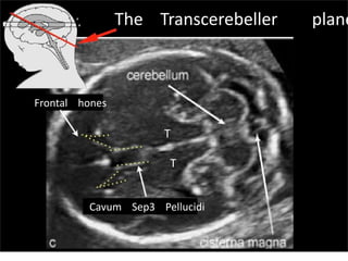 Cavum Sep3 Pellucidi
Frontal hones
T
T
The Transcerebeller plane
Sunday, July 28, 13
 