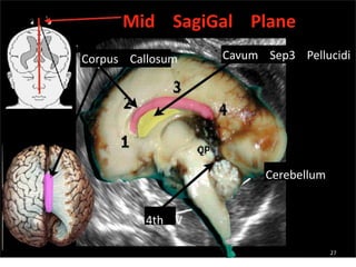 Mid SagiGal Plane
Corpus Callosum Cavum Sep3 Pellucidi
Cerebellum
4th V
27
 